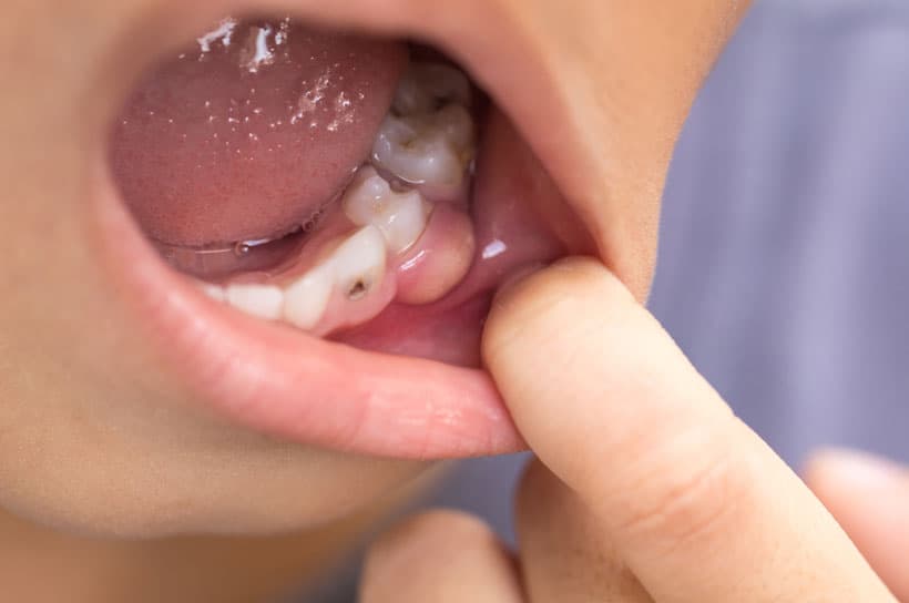 Caries en niños