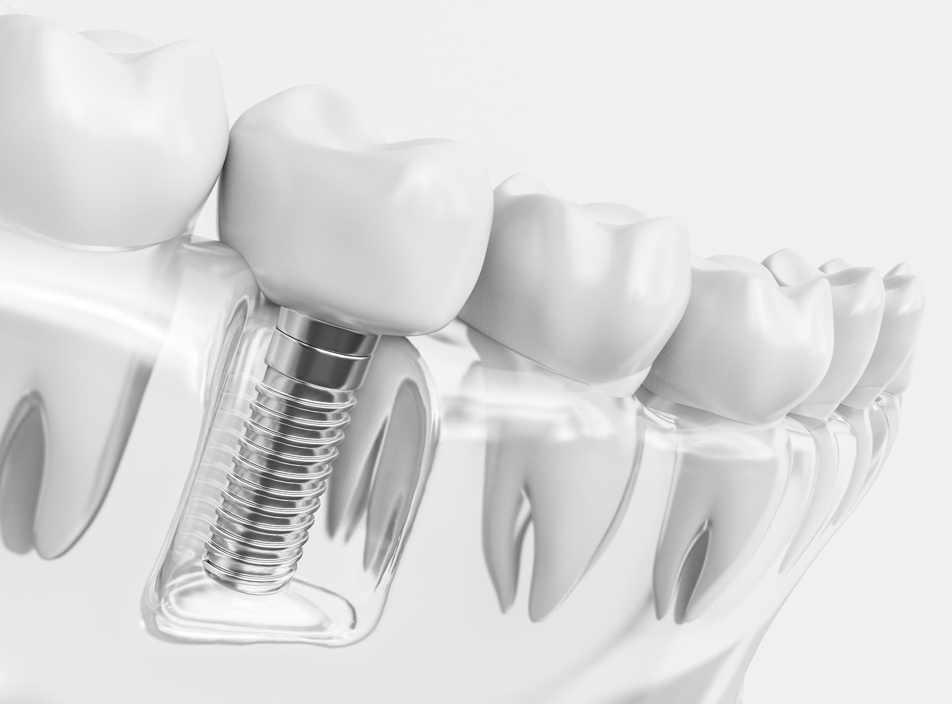 Implantología oral